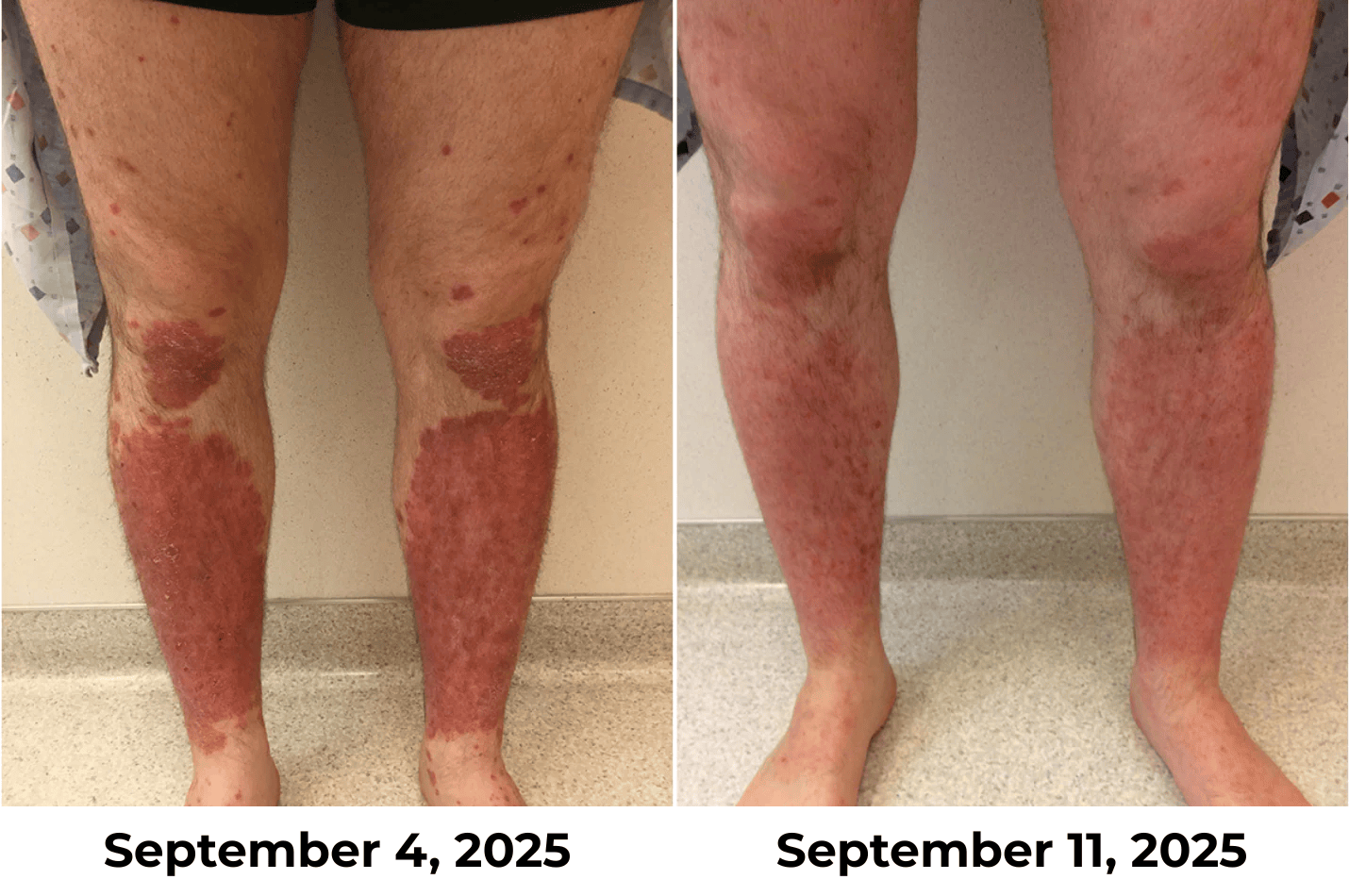 Official Store:LOVILDS® Magnesium Herbal Spray Fast Relief for Psoriasis & Eczema | No-Rub, SteroidFree