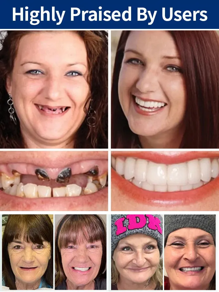 [FDA Certified] Perfectly Fitting Custom-Made Dentures【No glue needed, instant application in 1 second!】