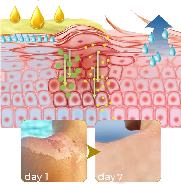 FurzeroTM Acanthosis Nigricans Peeling Oil