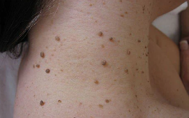 OveallgoTM WartsOff Instant Blemish Removal Cream
