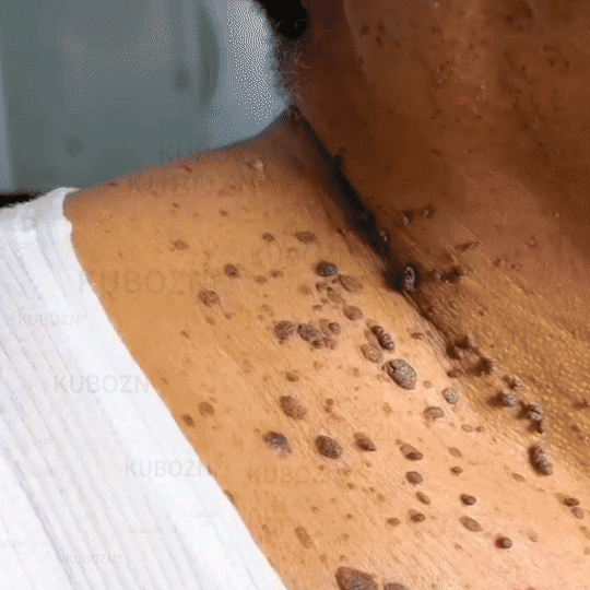 Dobshow® Wart and mole removal microneedle patch