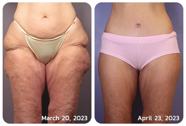 Laozik™ Botox Bee poison Firming Serum Stick