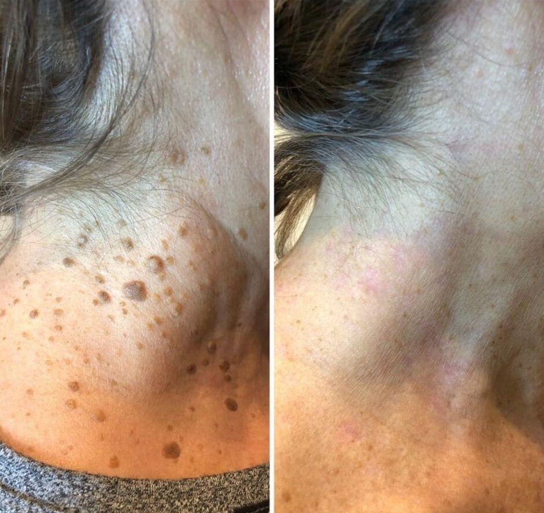 ROSOPL® WartLift Wart Removal Fluid 22 Timilk® WartLift Corn Removal Liquid (A)