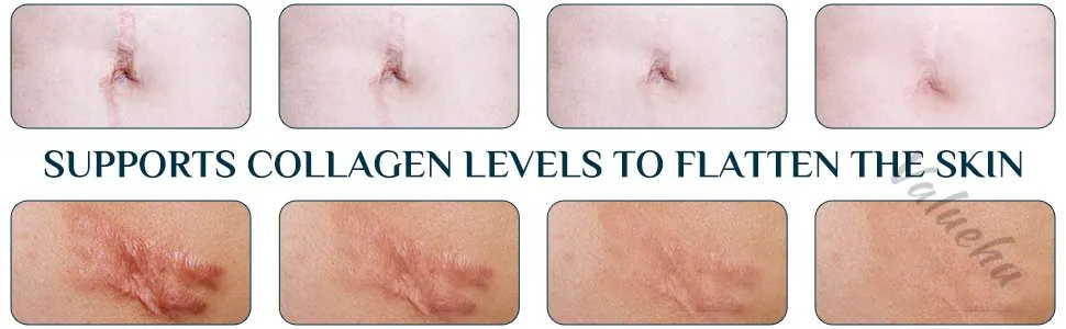 Mebak scar gel for old scars